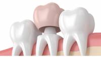 Dental Crowns