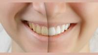 Tooth Whitening